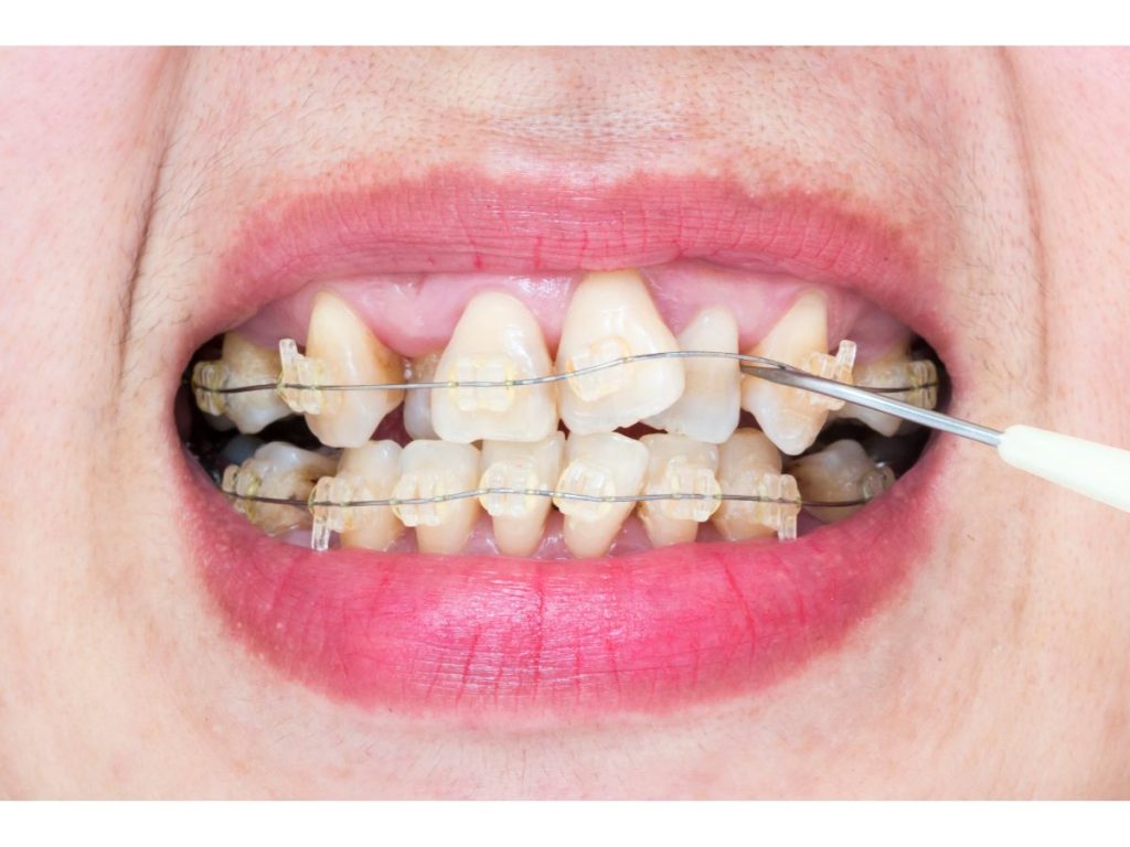 Comment corriger des dents de travers ?